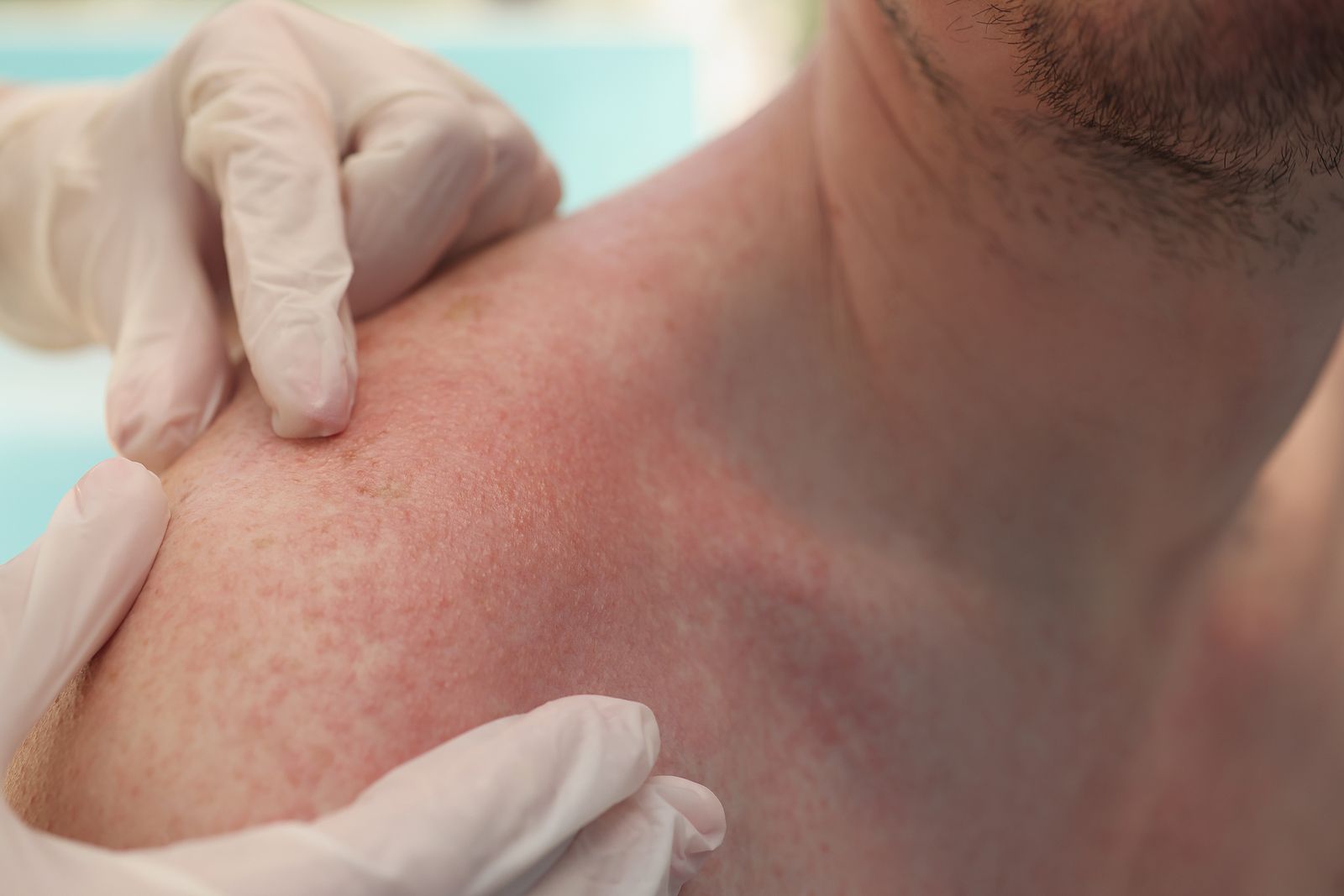 El envejecimiento de la población y la poca concienciación aumenta los casos de queratosis actínica