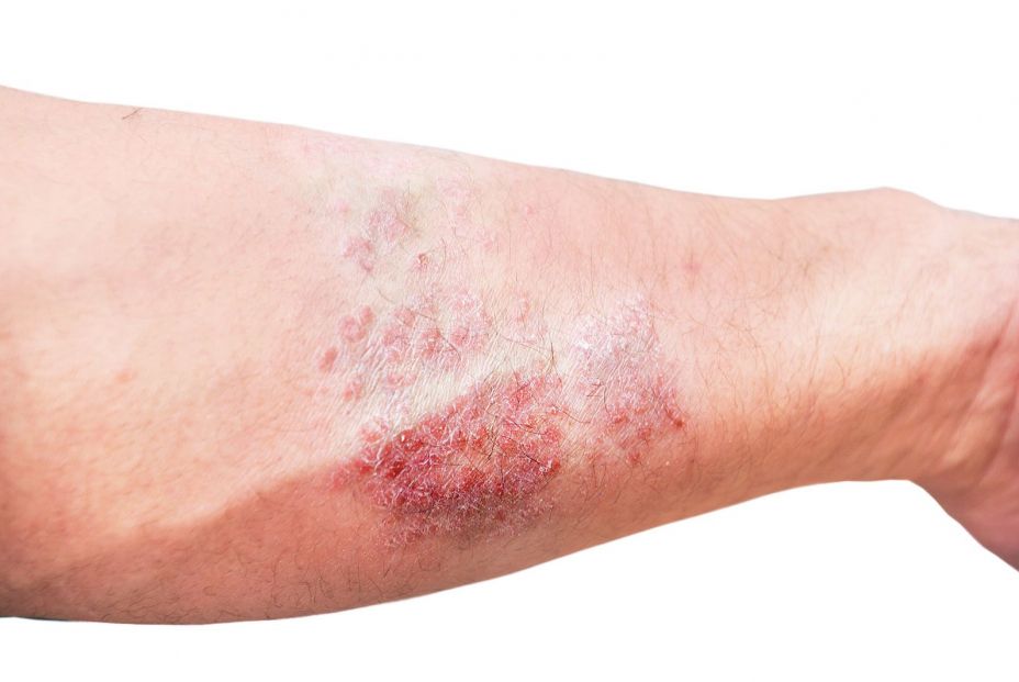 Un paciente con dermatitis atópica. Bigstock Un paciente con dermatitis atópica. Bigstock