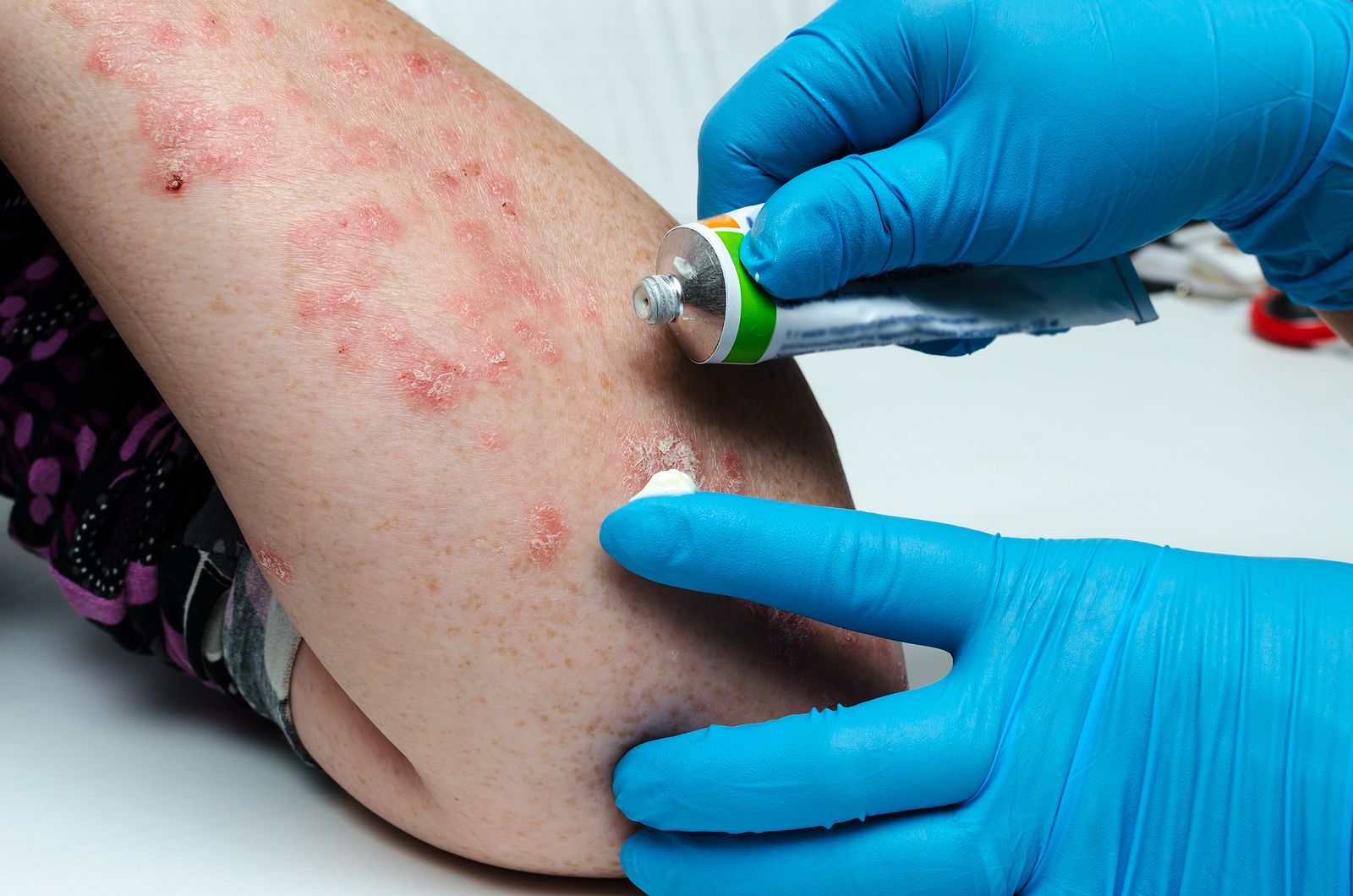 Esta es la alimentación que mejora la psoriasis. Bigstock 