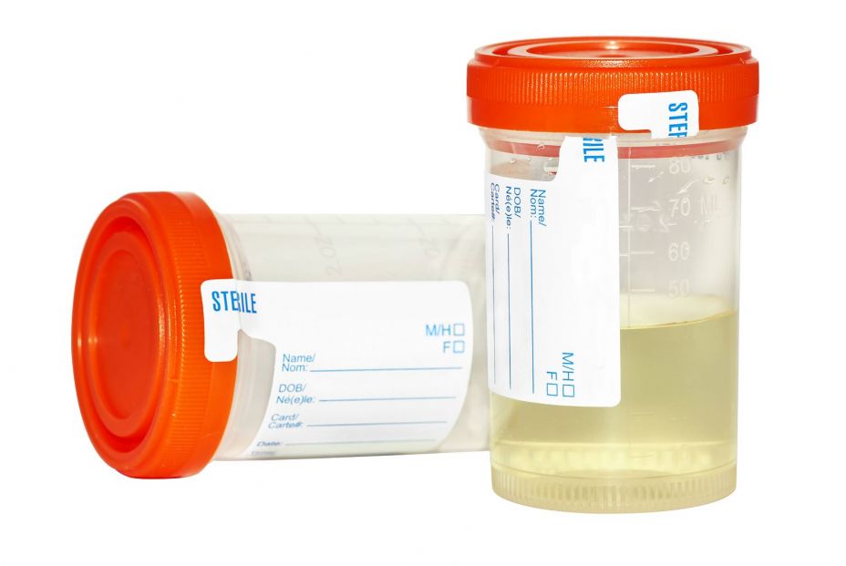 Recogida de muestras de orina. Bigstock Recogida de muestras de orina. Bigstock
