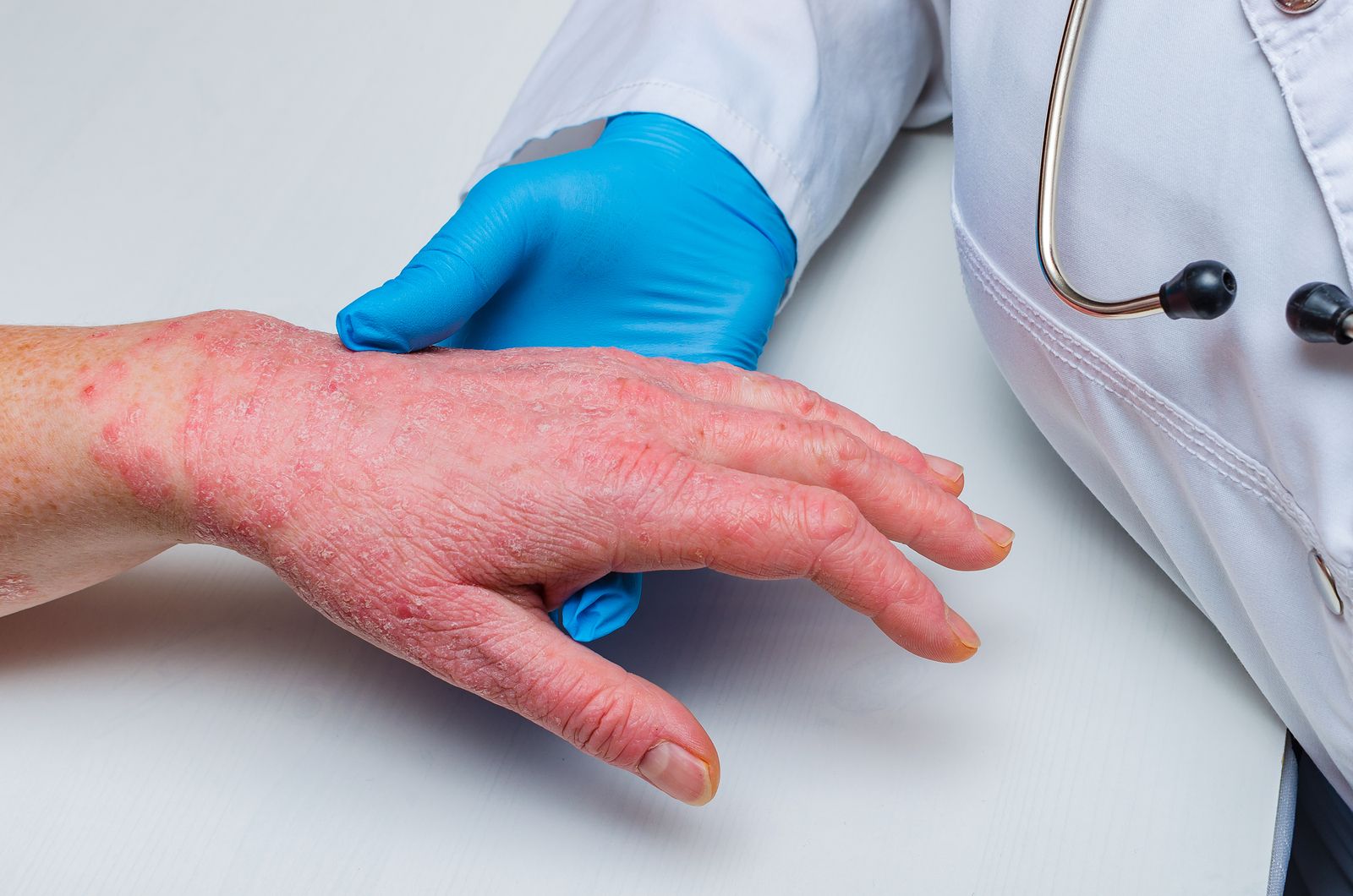 Una nueva terapia para la forma común de eccema: ¿también válida para los mayores? Una nueva terapia para la forma común de eccema: ¿también válida para los mayores?